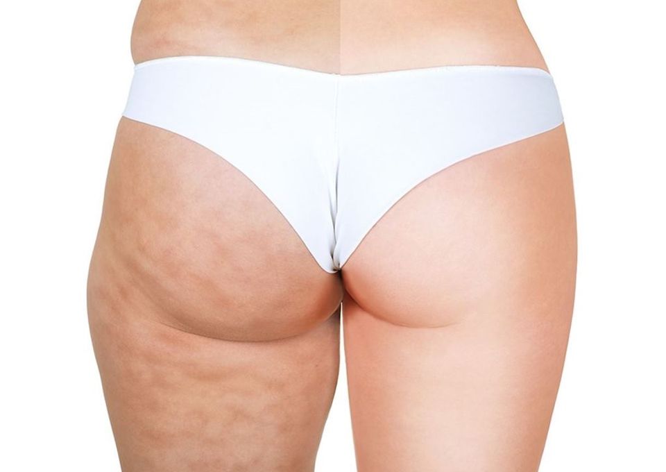 大腿肥胖紋、橘皮怎麼辦？皮膚科醫生：保濕是關鍵，加碼淡紋有感按摩+伸展運動！