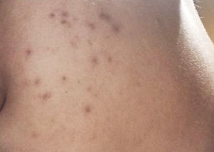 已生成的紅色痘疤、深色痘疤怎麼辦？長痘後續保養「這樣做」就能淡痘疤