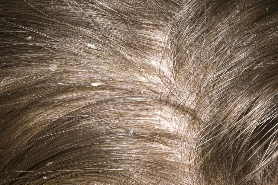 吃黑芝麻真的可以讓頭髮長更快？5觀念更新，碰到頭皮屑這樣做