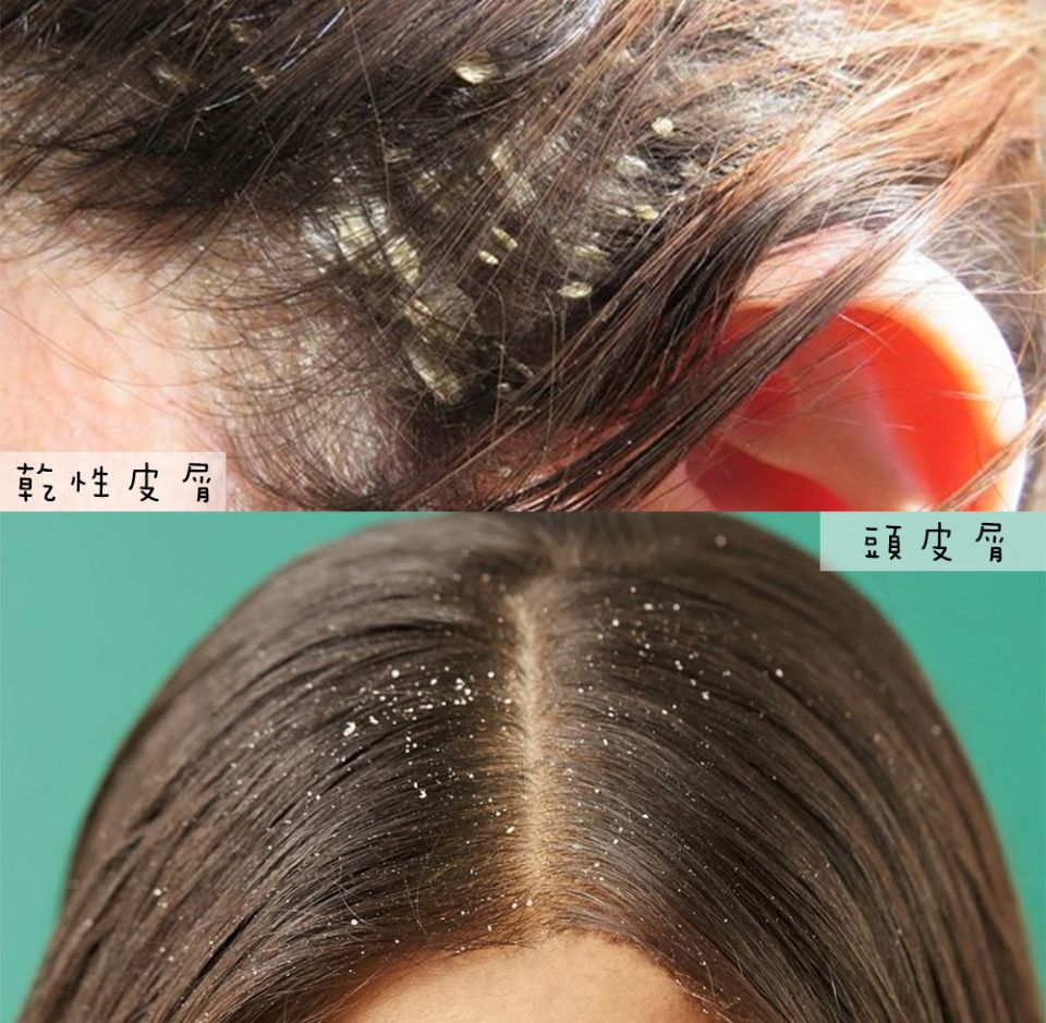 冬天頭皮屑變嚴重，怎麼改善?抗屑洗髮精怎麼選？專業醫師全解答!