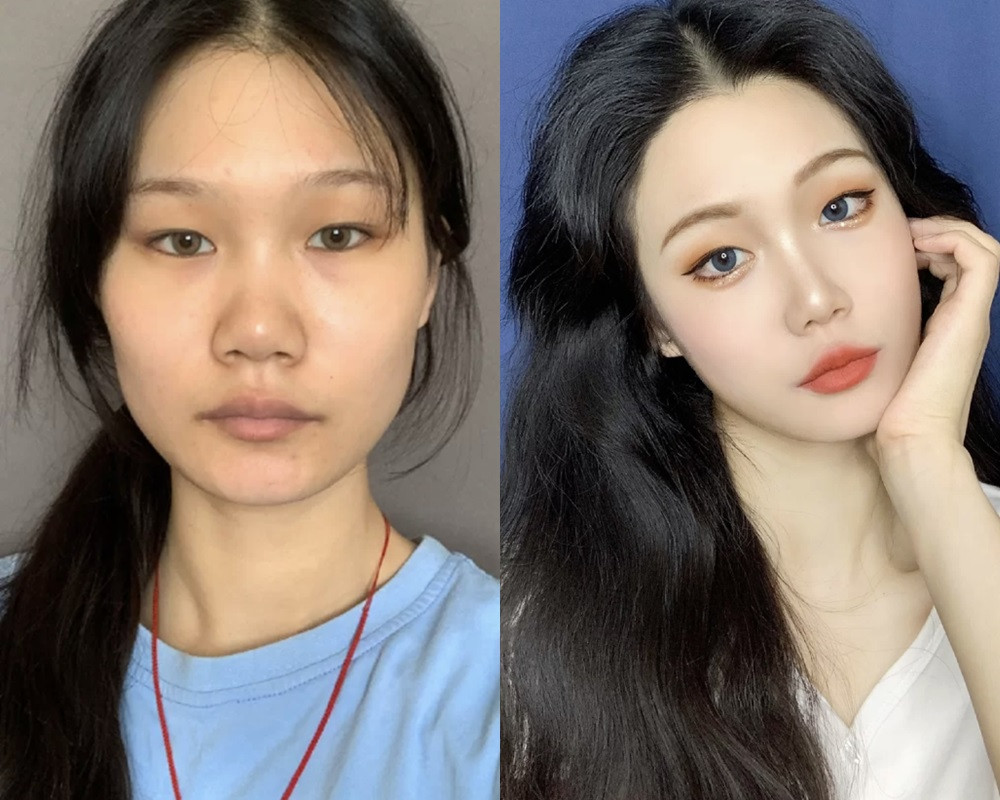 腫泡內雙眼線完成